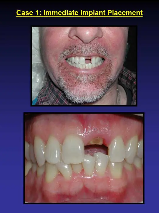 immediate implant placement