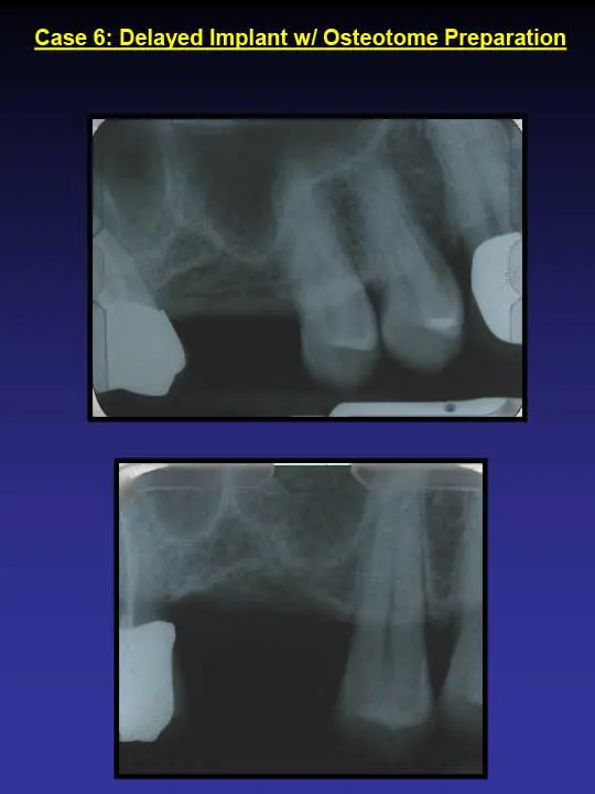 before dental implants