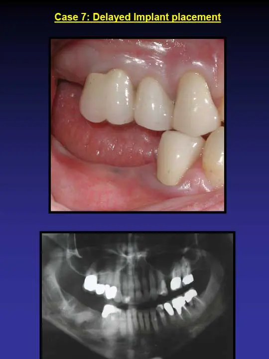 dental implant placement