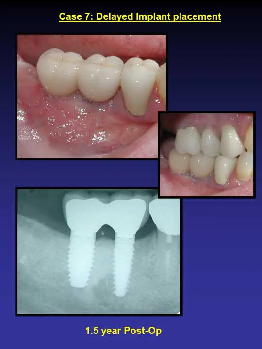 1.5 year post-op implant placement