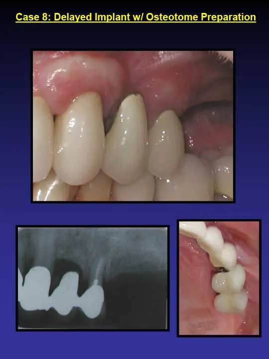dental implants
