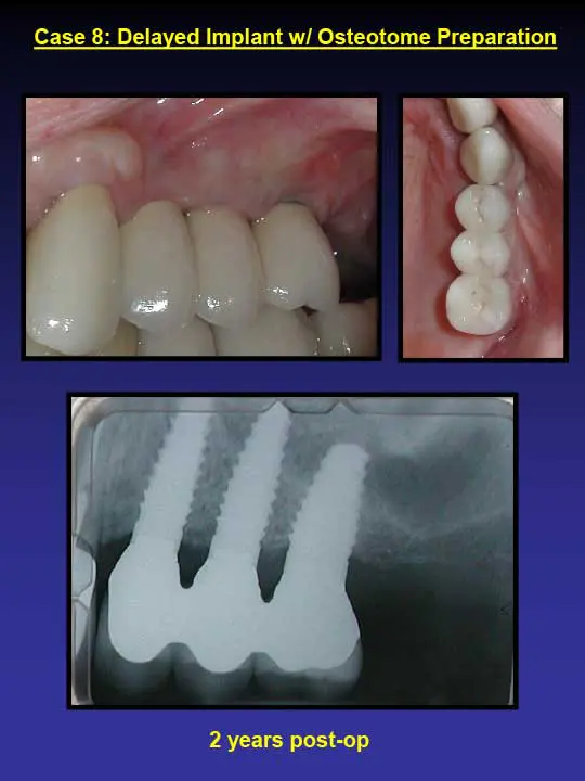 2 years post-op dental implant