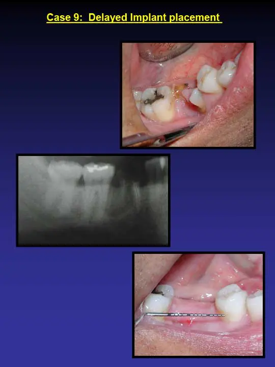 before dental implants