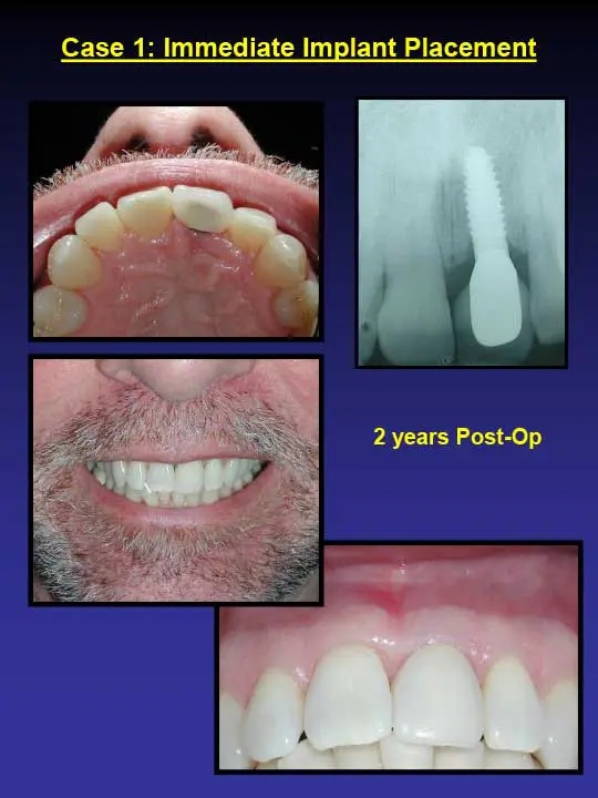 immediate implant placement