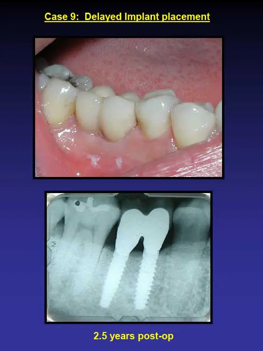 after dental implants