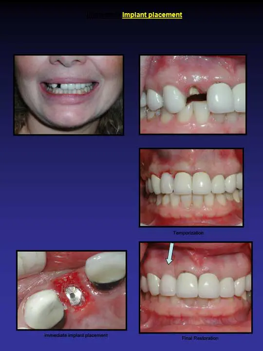 implant placement