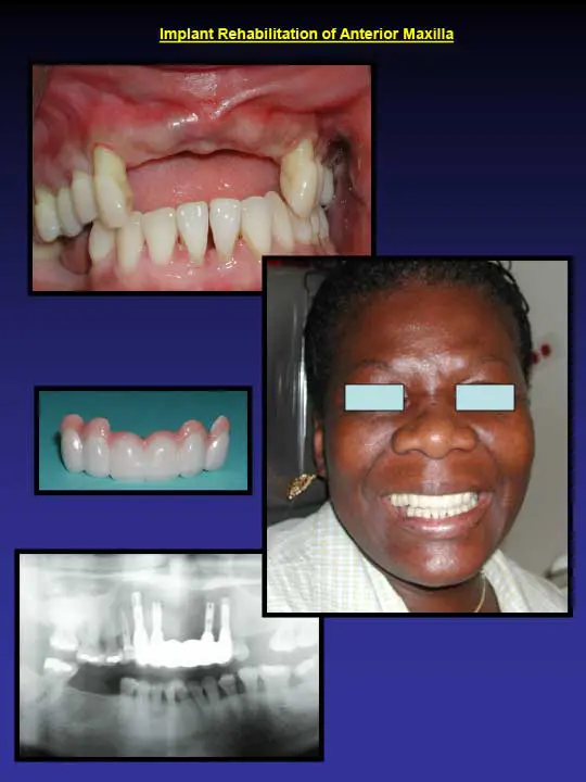 implant rehabilitation of anterior maxilla