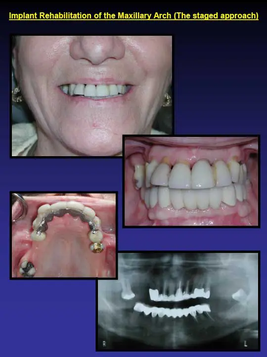 implant rehabilitation of maxillary arch