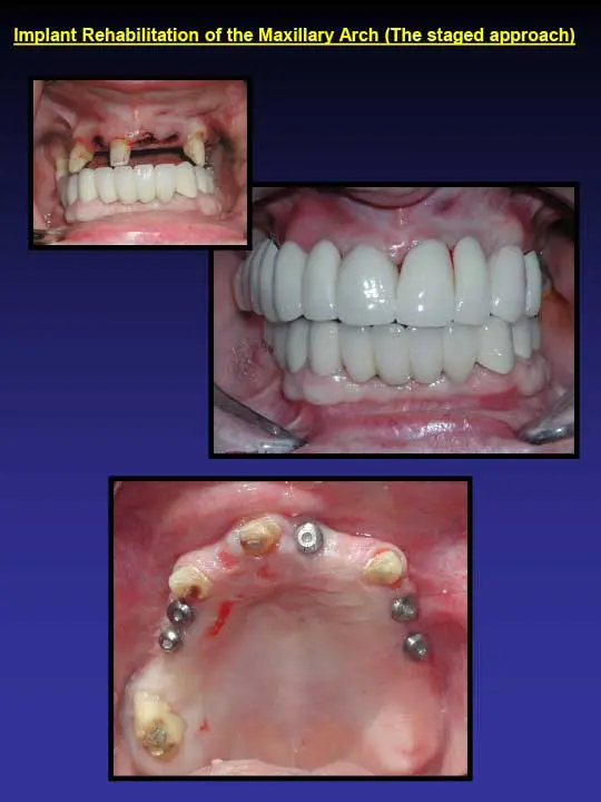 implant rehabilitation of the maxillary arch