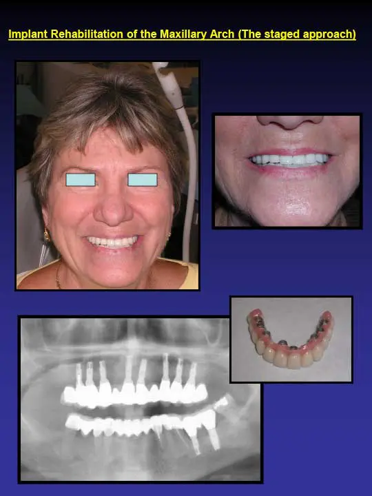 implant rehabilitation of the maxillary arch