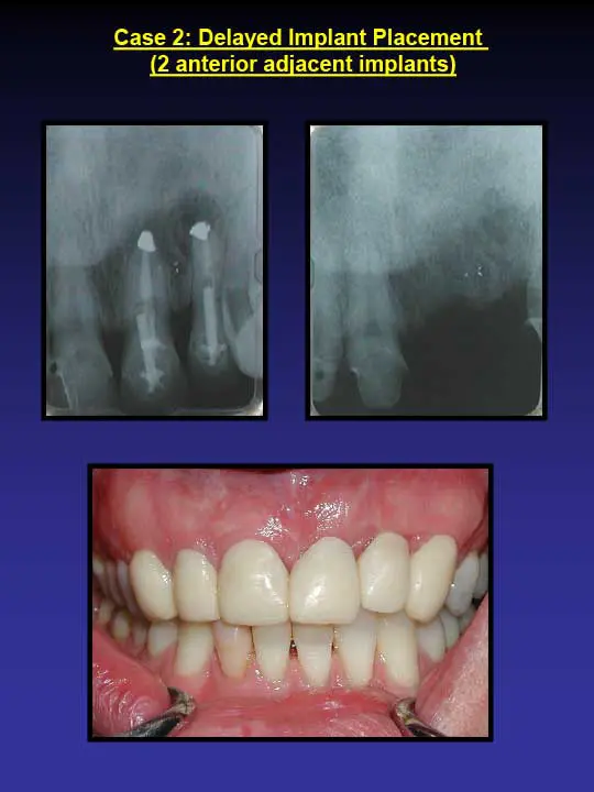 implant-placement