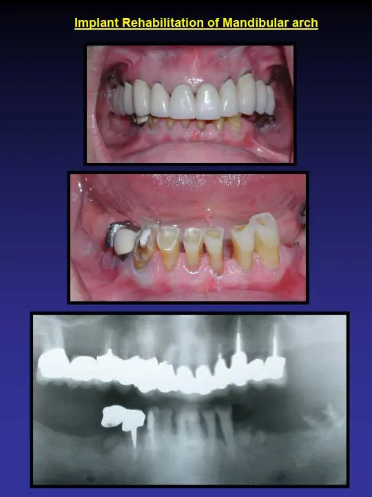 implant rehabilitation of mandibular arch