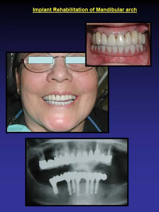 implant rehabilitation of mandibular arch