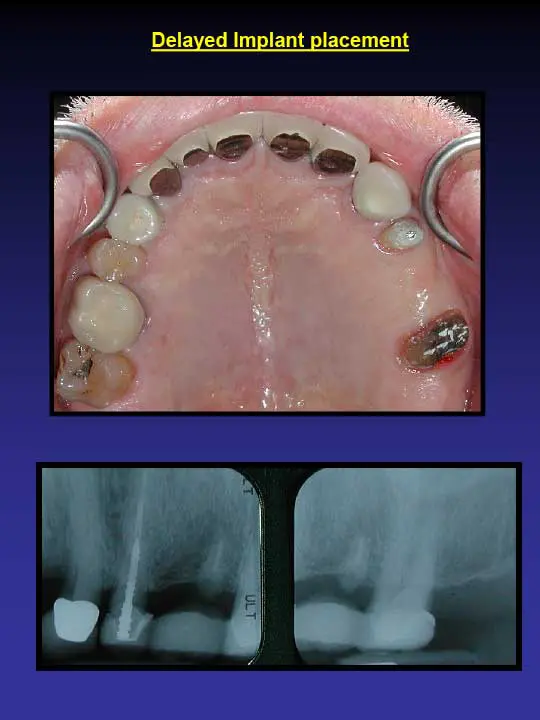 implant placement