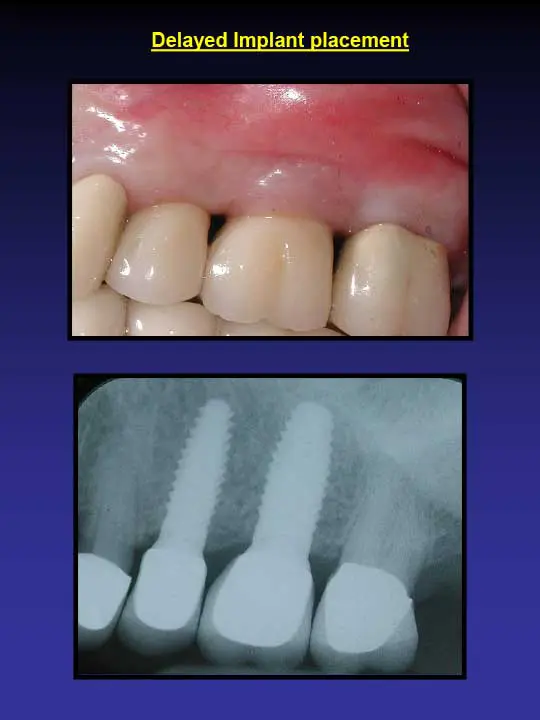 implant placement