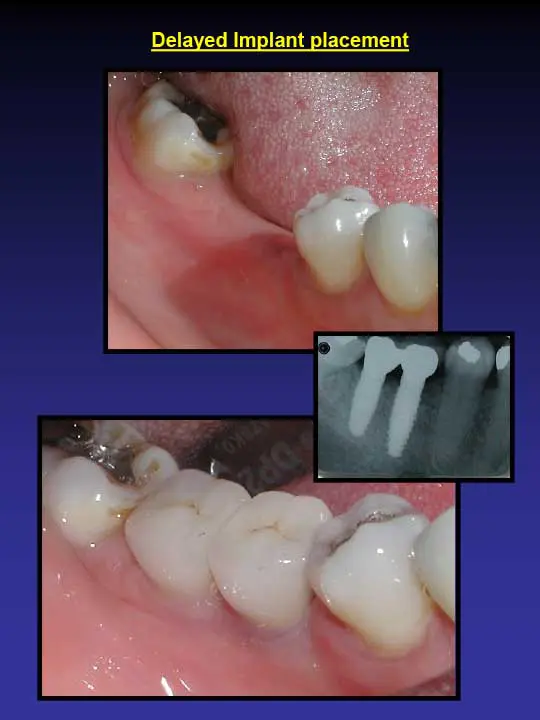 implant placement