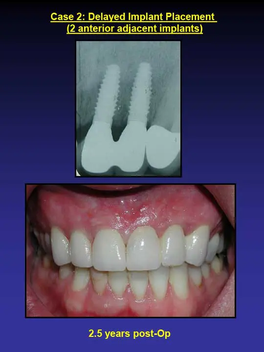 2.5 years implant post-op