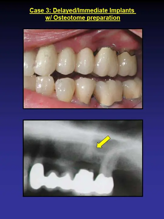 immediate implant with osteotome preparation
