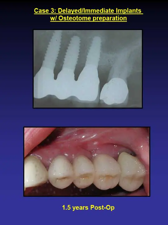 1.5 years post-op implants