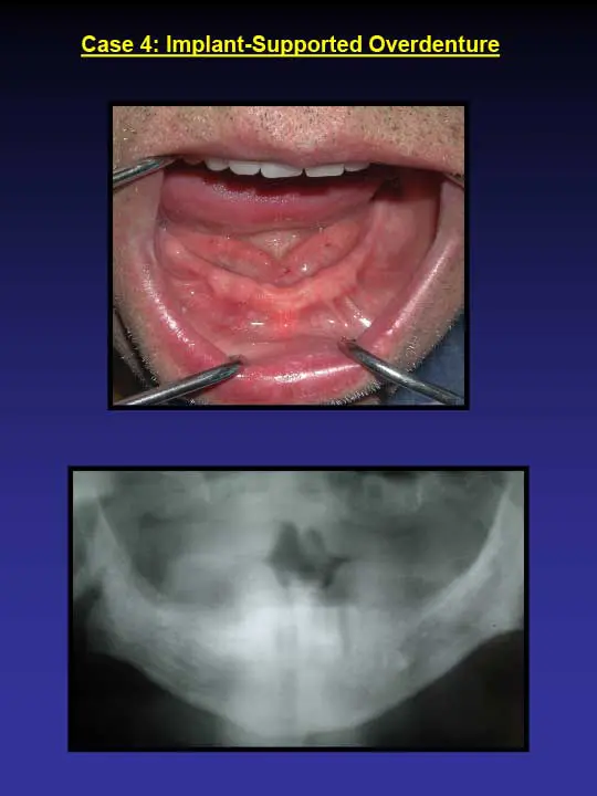 implant supported overdenture