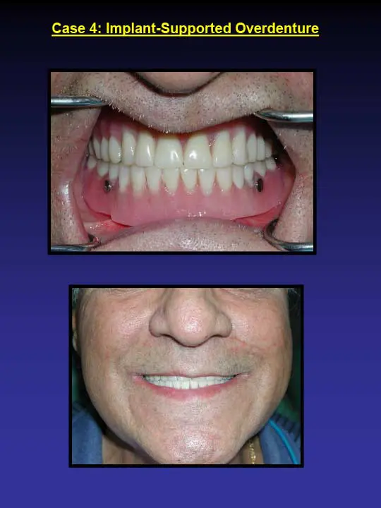 implant supported overdenture