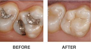 CEREC-before-after-image-304x163