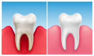 Vector illustration of gum disease - periodontitis in compare with healthy white tooth