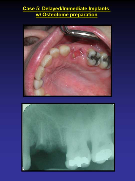 immediate implant with osteotome preparation