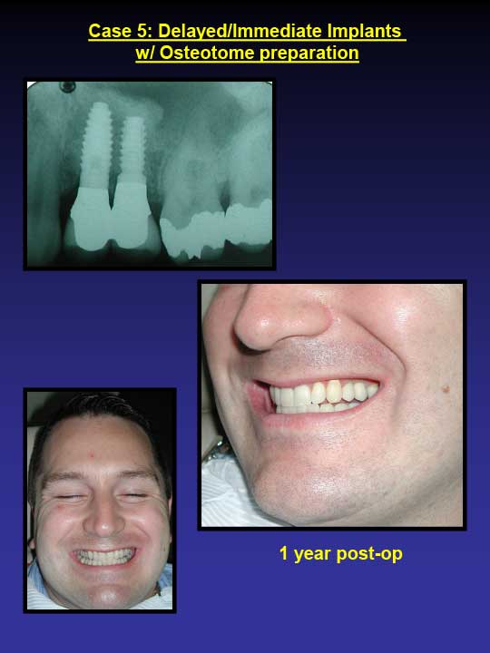 1 year post-op immediate implants