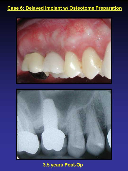 3.5 years post-op dental implants