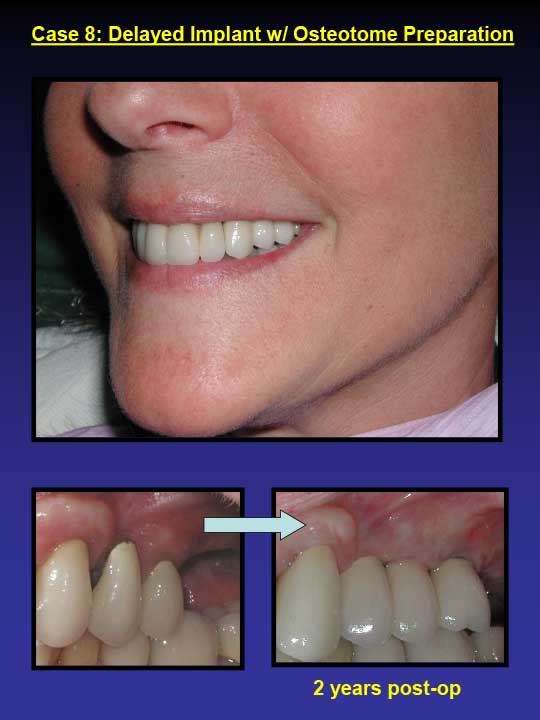 2 years post-op dental implants