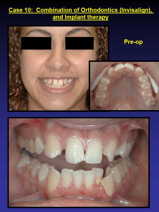 before invisalign and implant therapy