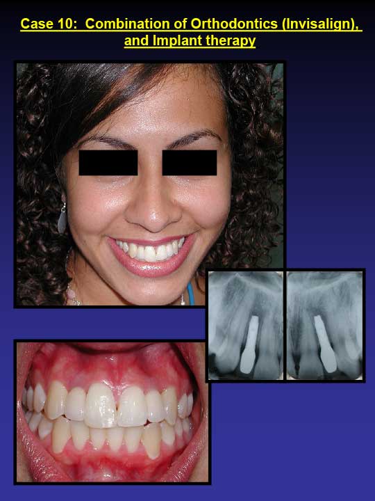 after invisalign and dental implant therapy