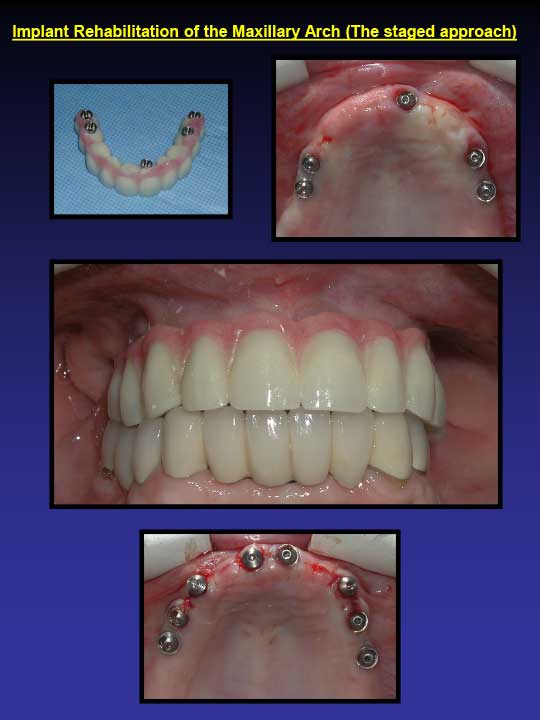 implant rehabilitation of the maxillary arch