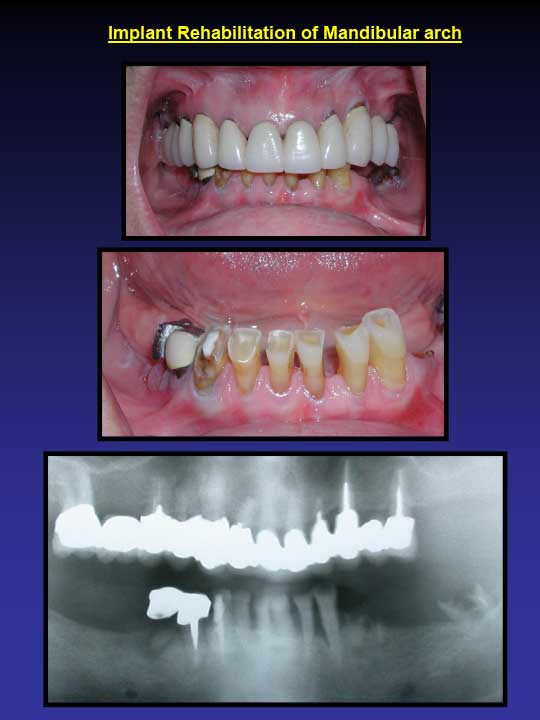 implant rehabilitation of mandibular arch