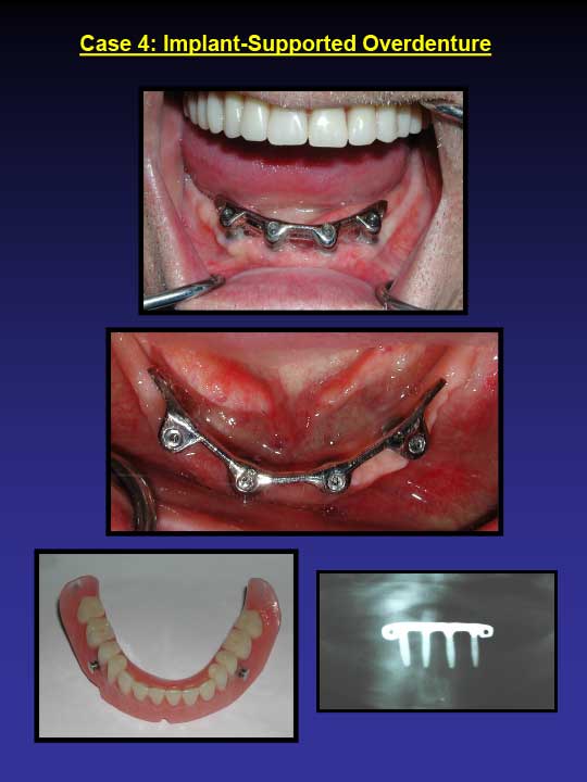 implant supported overdenture