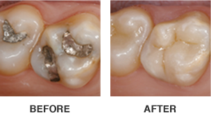 CEREC-before-after-image-304x163